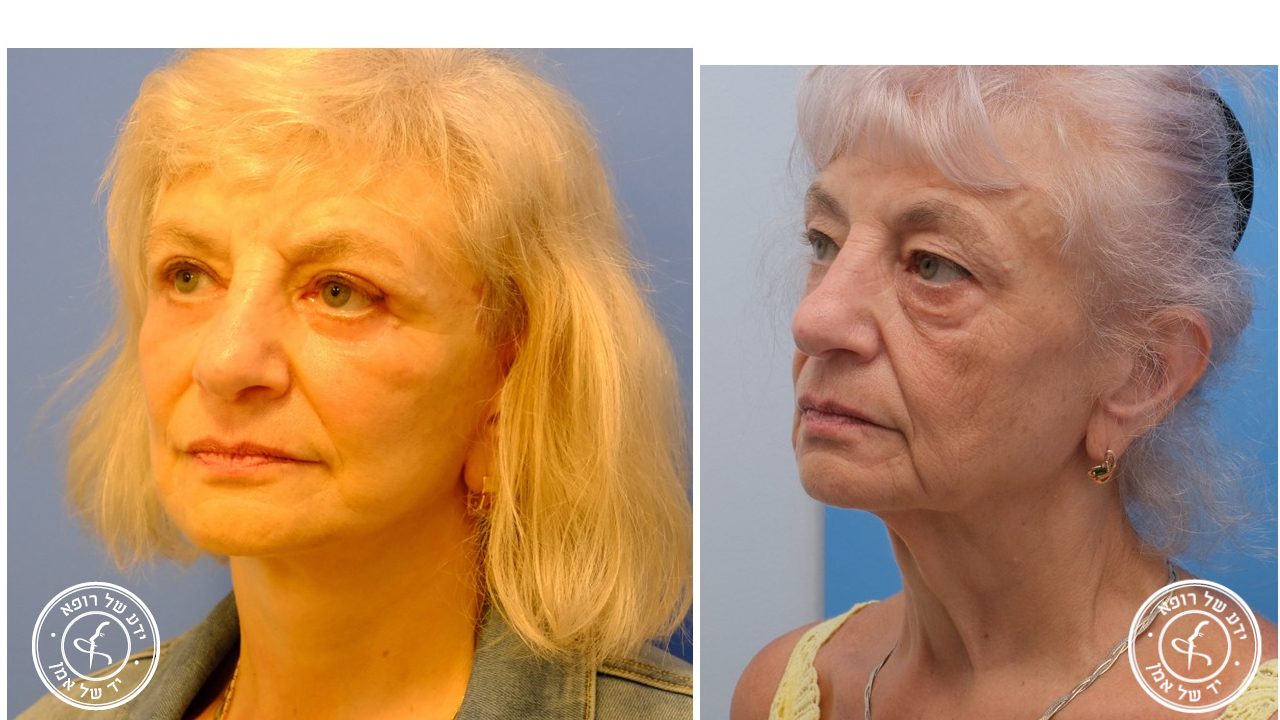 1. תמונת לפני ואחרי של אישה שעברה ניתוח מתיחת פנים, המציגה את השינוי הדרמטי.